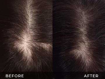 Hair Restoration Before After
