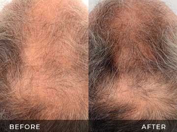 Hair Restoration Before After