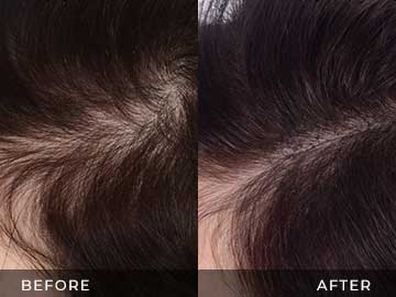 Hair Restoration Before After
