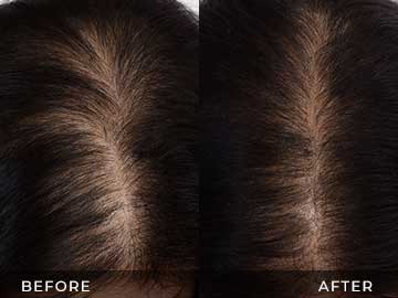 Hair Restoration Before After