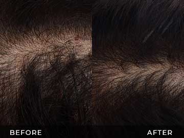 Hair Restoration Before After