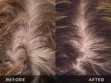 Hair Restoration Before After