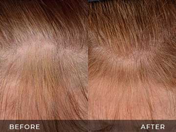 Hair Restoration Before After