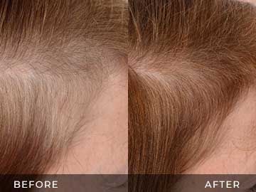 Hair Restoration Before After