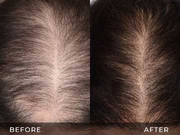 Hair Restoration Before After